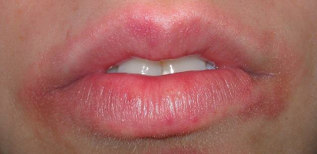 What Causes Rash And Swollen Lips Just Health